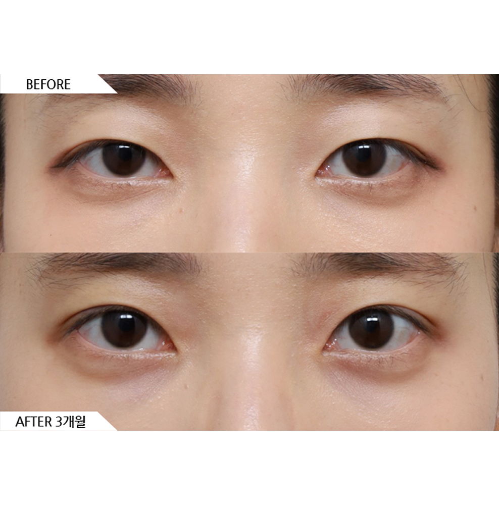 Before and after results of custom eye surgery and ptosis correction showing balanced and natural eye shape in Korea