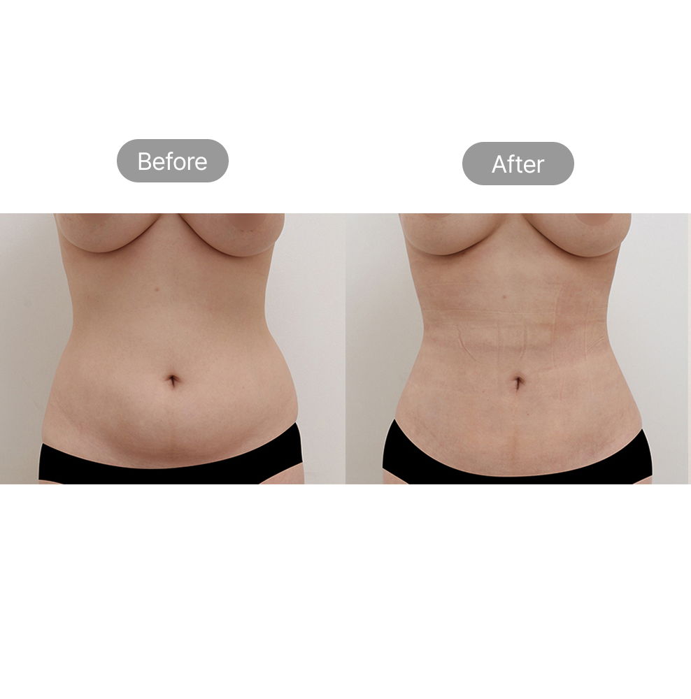 Abdomen fat removal before and after results for a slimmer waist at Fresh Dr. Hong in Korea