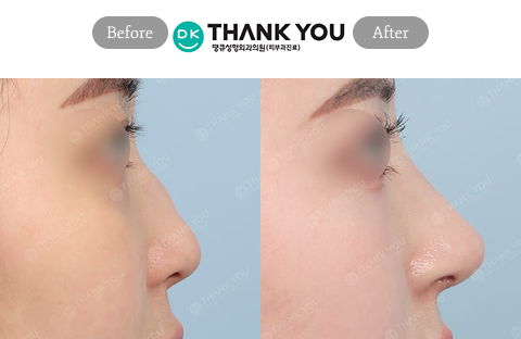 Closed Rhinoplasty Korea Before and After in Plastic Surgery Korea