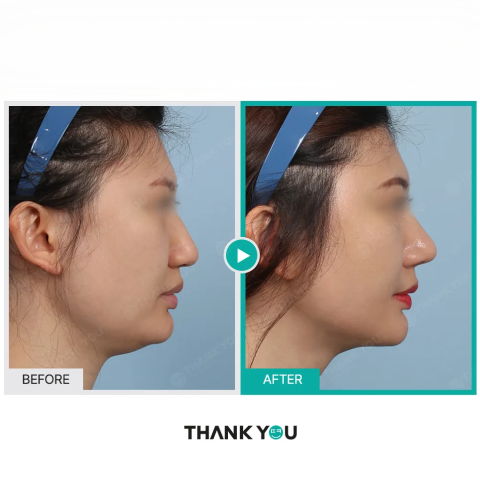 Face Lift Using Threads Before and After – Jawline Thread Lift in Korea by Jivaka Beauty