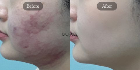 Acne and Rosacea Combination Laser Treatment Before and After Results