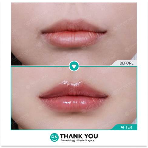 Lip filler and corner botox before and after treatment achieving softer contours and a refreshed smile