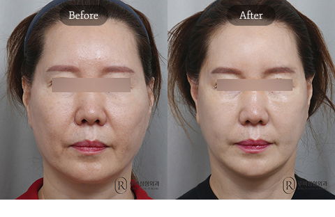 Plastic Surgery Recovery Timeline at 1 Month Showing Reduced Swelling and Early Visible Results