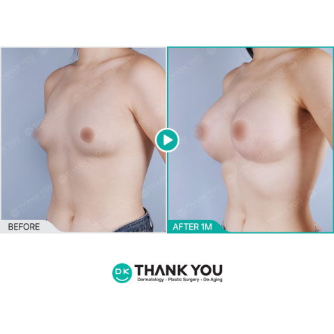 Mommy Makeover Korea Breast Augmentation Before and After Results at Thank You Plastic Surgery Clinic