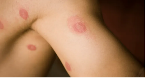 Someone with ringworm, their arm and armpit showing the round patches typical of ringworm, red but clear in the middle