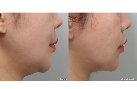 Early lifting results for sagging skin after 4 weeks using HIFU treatments such as Ultherapy and Shurink in Korea