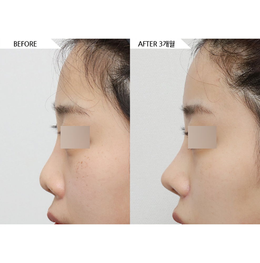 Before and after results of revision rhinoplasty and bulbous nose correction showing a more refined and natural nose profile in Korea