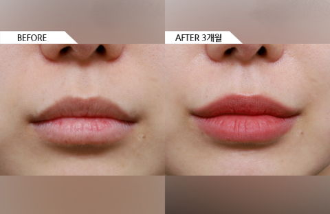 Bullhorn lip lift before and after surgery with philtrum shortening and enhanced upper lip show