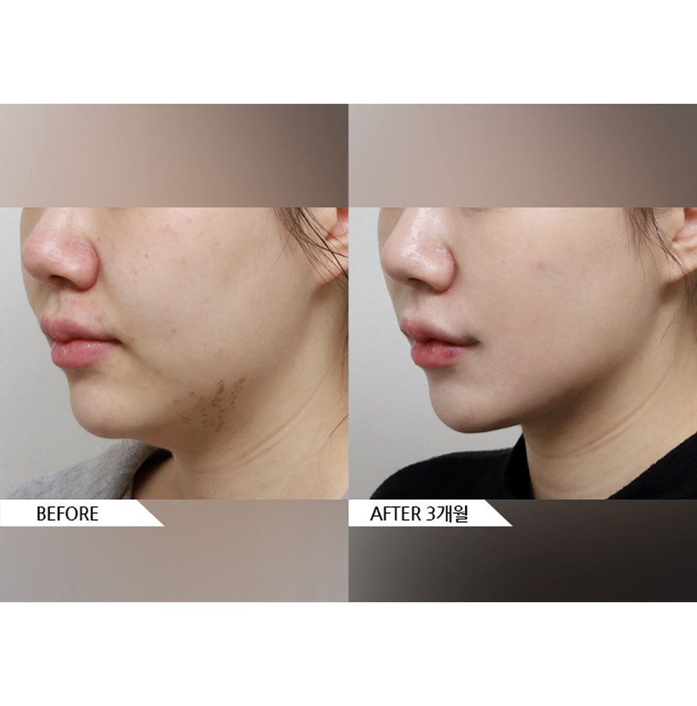 Before and after facial liposuction results showing double chin removal and a more defined V-line jawline 3 months after treatment in Korea