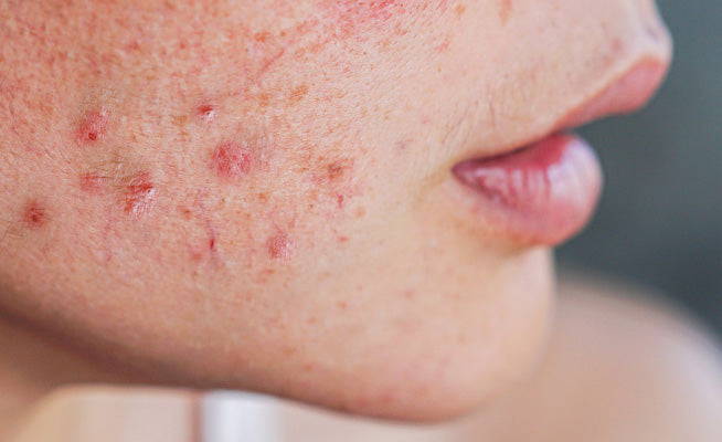 How to Treat Hormonal Acne at Any Age