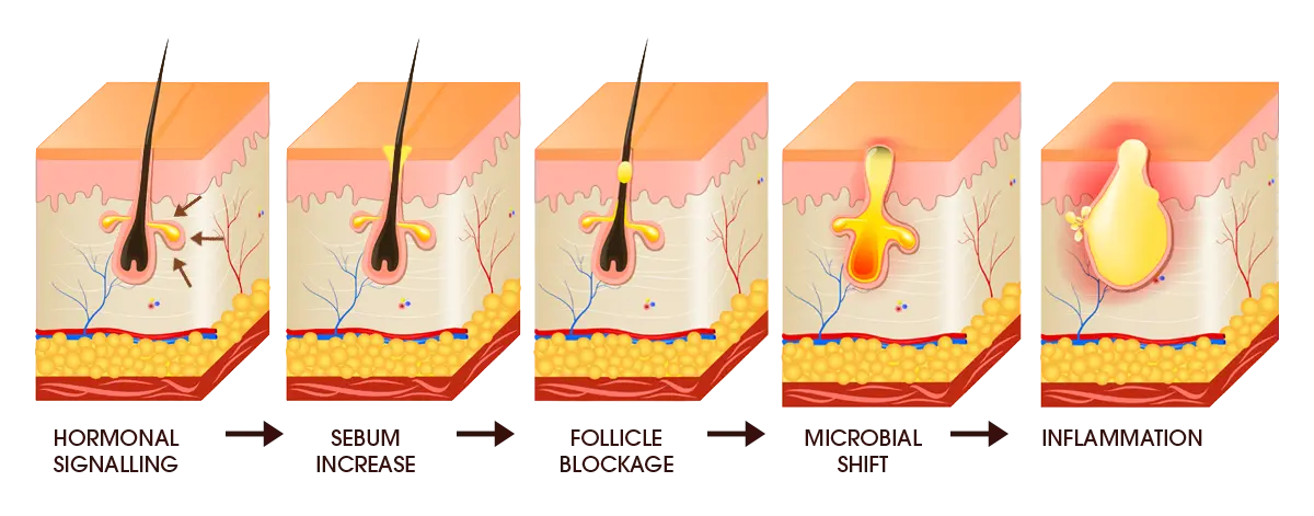 Illustration of hair acne stages: hormonal signalling, sebum increase, follicle blockage, microbial shift, and inflammation processes.