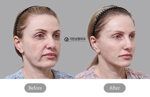 Plastic Surgery Recovery Timeline Showing Healing Progress and Visible Results Over Time