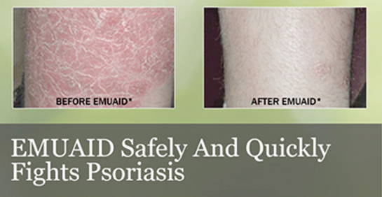 A picture of psoriasis on legs