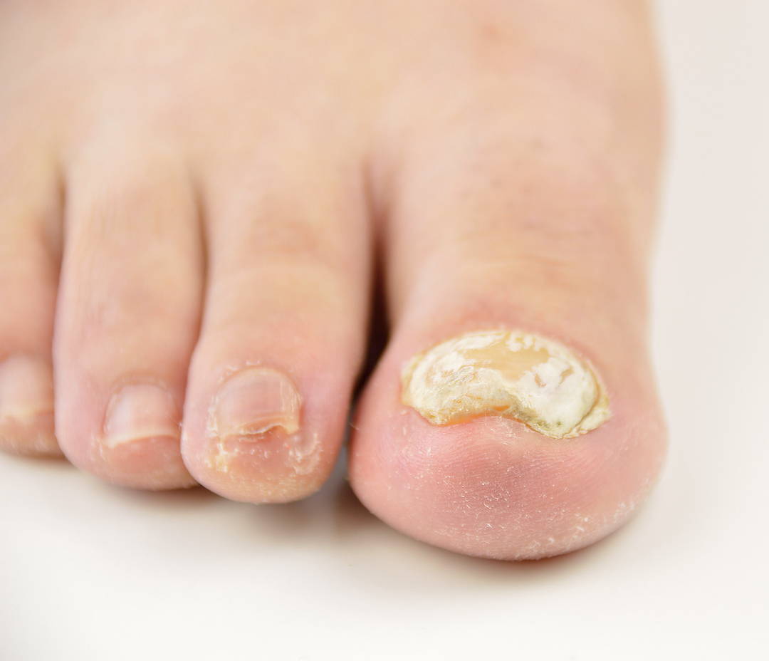 Esta es una imagen de hongos en las uñas de los pies.