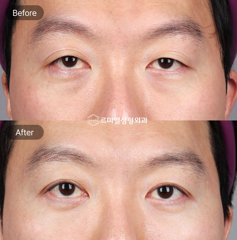 Before and After Results of Non Incisional Ptosis Correction for a Middle Aged Male After Two Months