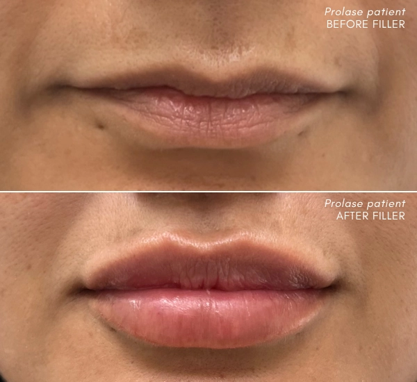 Prolase Patient before and after 2 ml if Juvederm Ultra xc 2 sessions Mane Kharbertyan