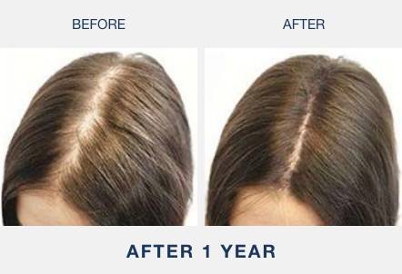 white woman regrowing hair at the part after using an illumiflow laser cap