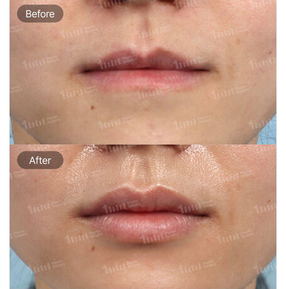 Male Lip Filler Before and After Results at 1MM Plastic Surgery in Korea for Natural and Defined Lip Volume