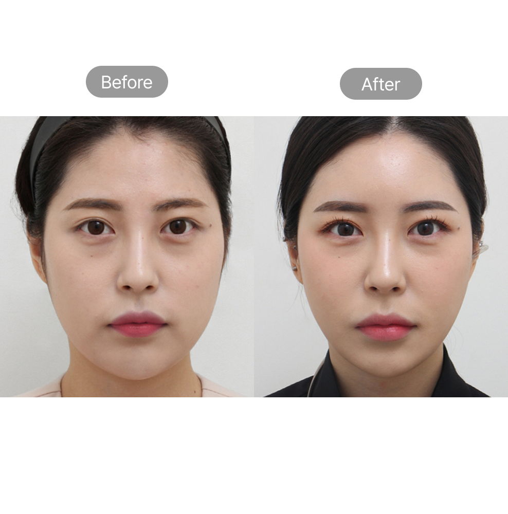 V-line facial contouring before and after results for a slimmer face at Fresh Dr. Hong in Korea