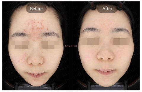 Korean Summer Skin Treatments for Inflammatory Acne and Acne Marks with Gold PTT and NeoBeam Laser Therapy