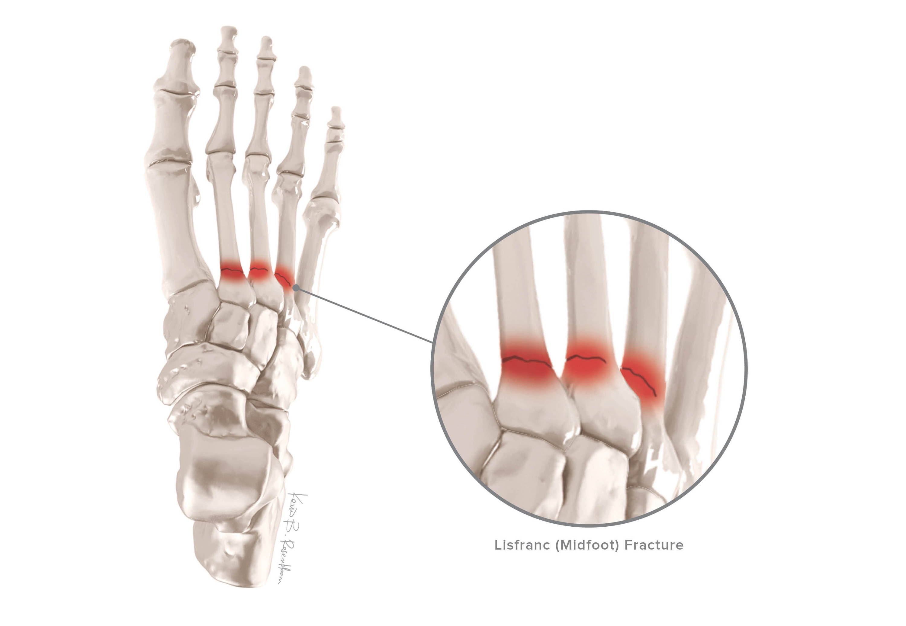 Lisfranc Injuries