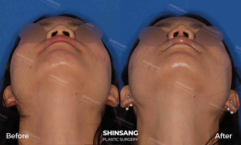 Alar Reduction Before And After Result At Sinsang Plastic Surgery In Korea