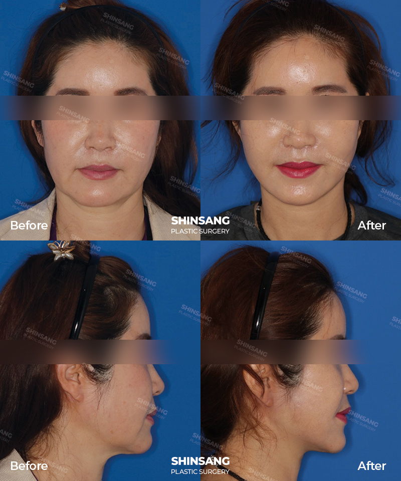 Mini Facelift Before And After Result At Sinsang Plastic Surgery In Korea