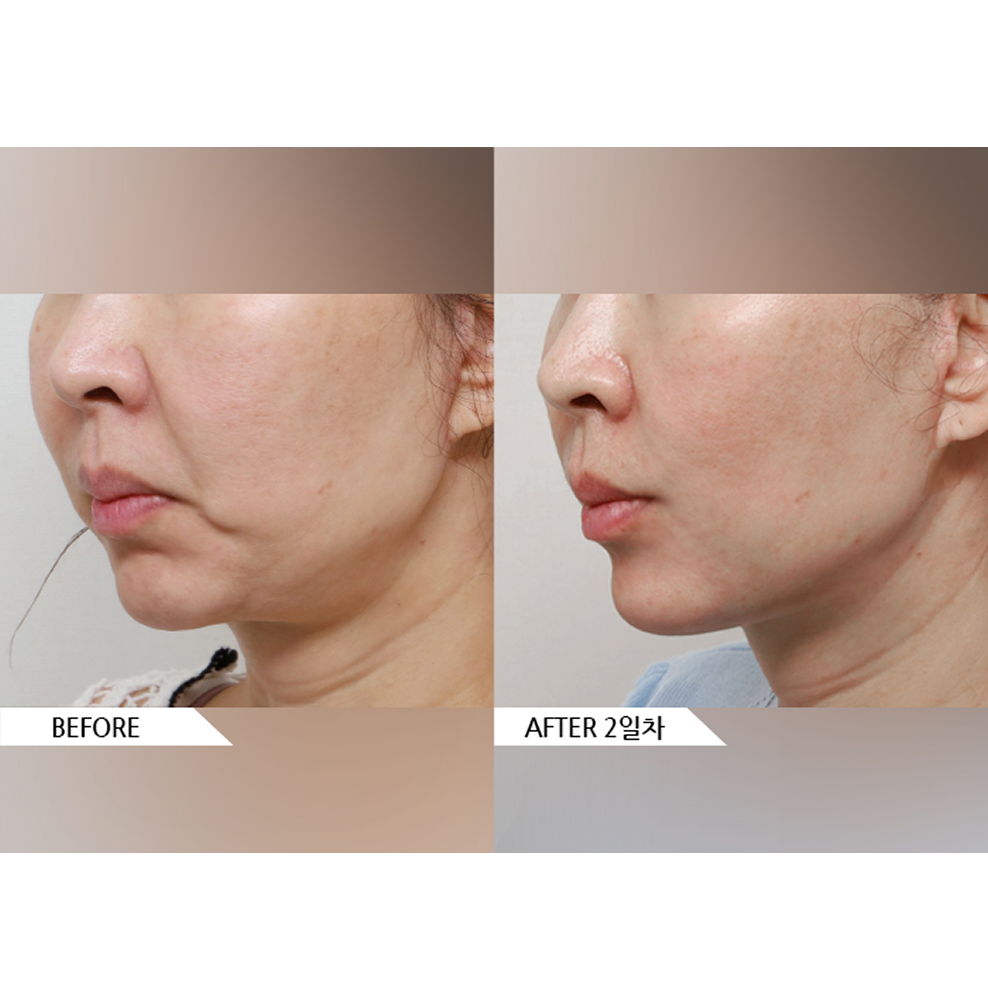 Before and after results of facial liposuction, lifting, and fat graft showing slimmer jawline and improved facial contour in Korea