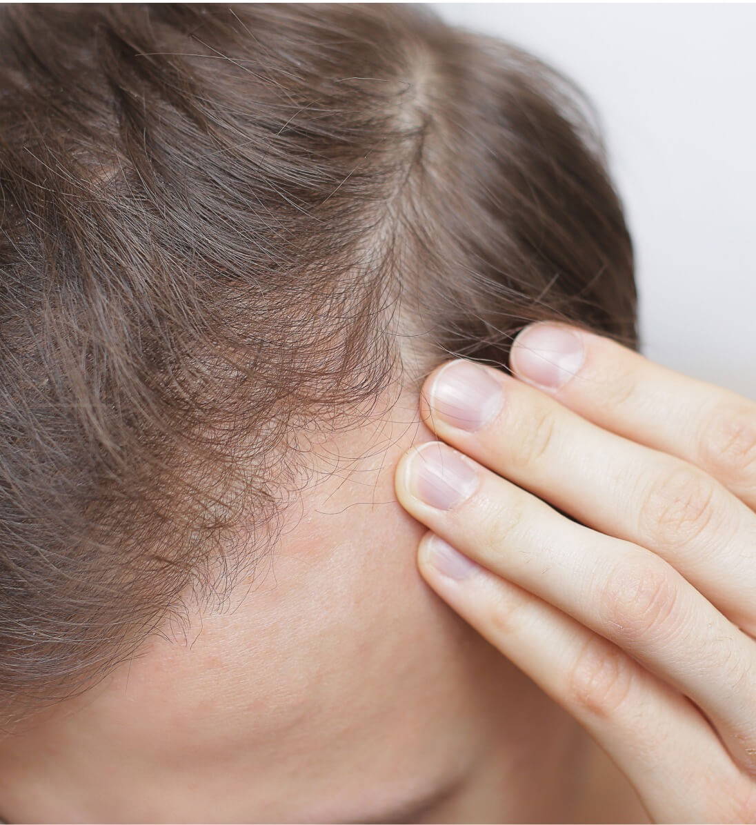 Hair Loss in Men - How to Identify & Treat Male Pattern Balding – Capillus