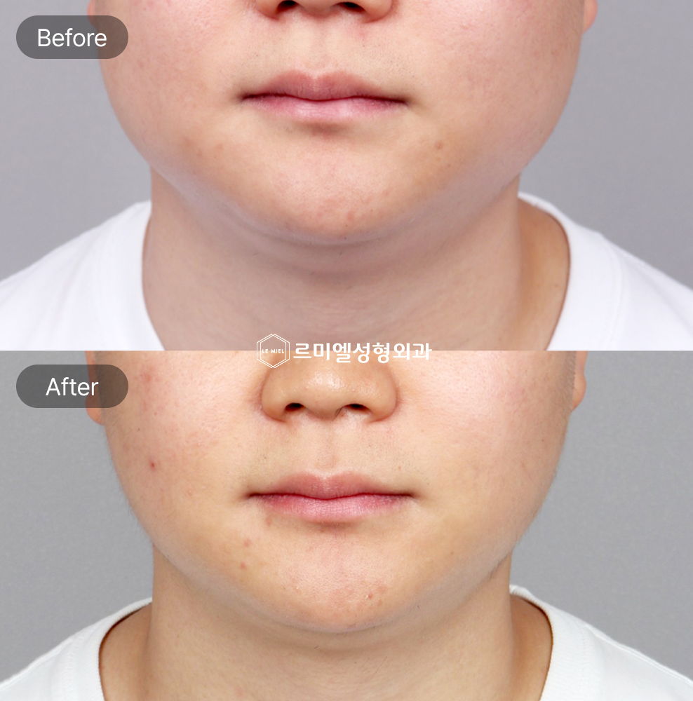 Before and After Results of InMode Lifting Treatment After Three Months