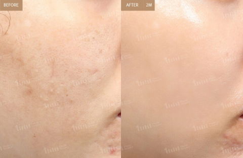 Two-Month Before And After Review Image Of Rejuran Treatment At 1mm Plastic Surgery Clinic