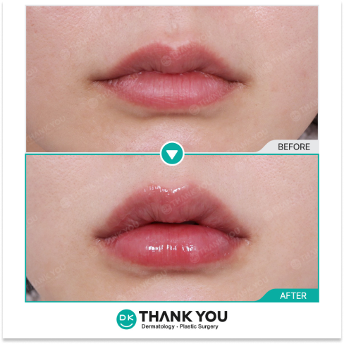 Korean lip contouring before and after using lip filler and corner botox for refined shape and natural volume