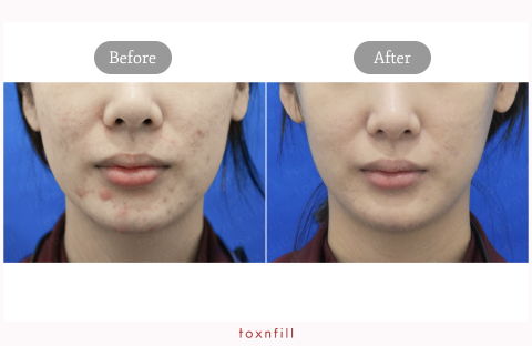 Acne Scar Skin Booster Treatment Before and After Results in Korea