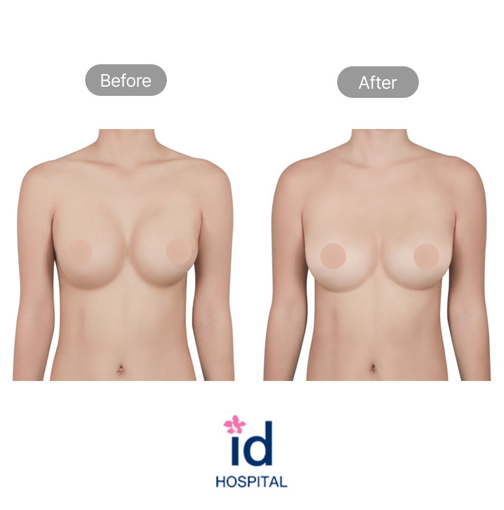 Motiva Breast Augmentation Revision Before and After Result at ID Hospital