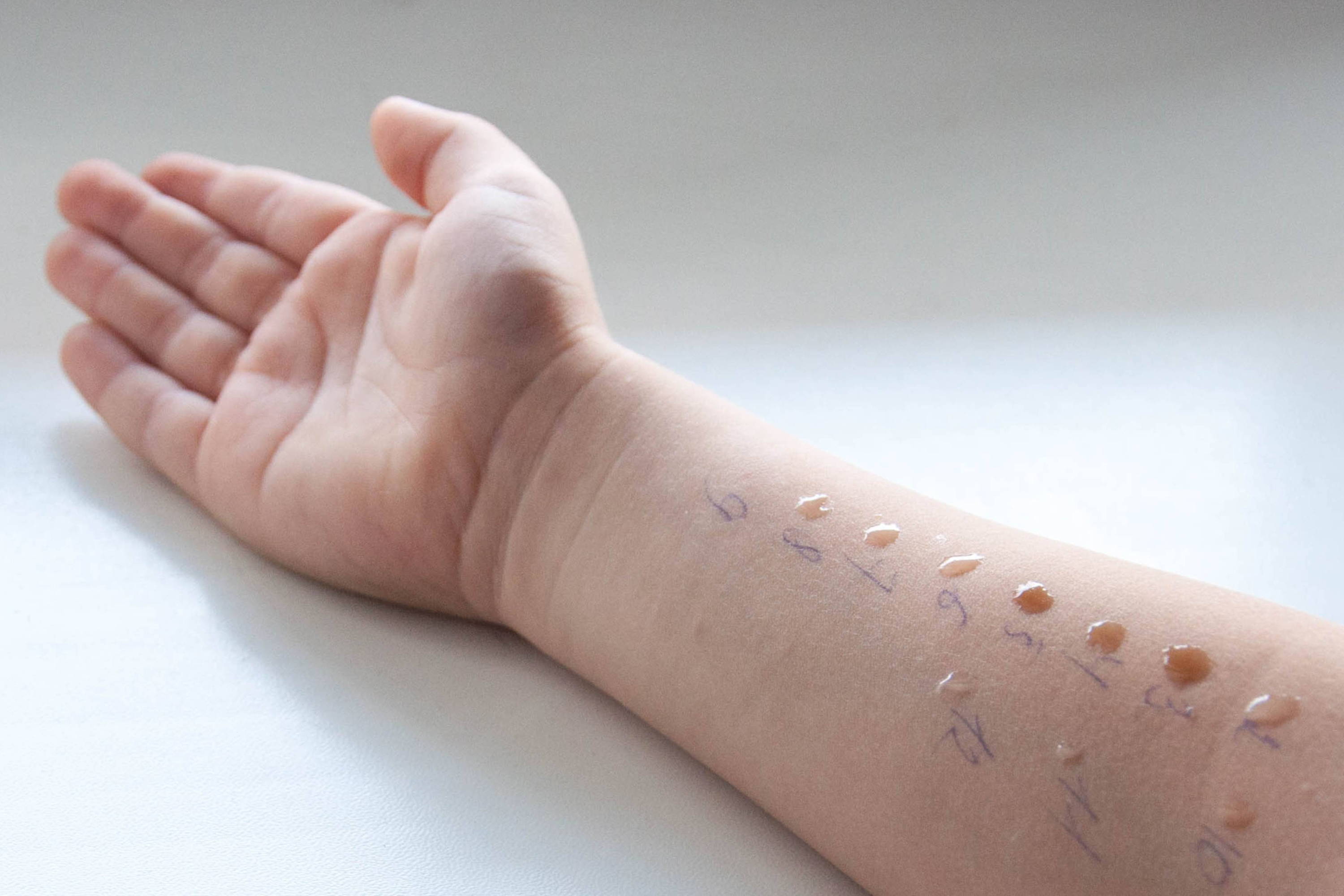 Detská ruka počas kožného prick testu - kvapky tekutiny obsahujúce malé množstvo alergénov môžu spôsobiť reakciu podobnú štípancu od komára