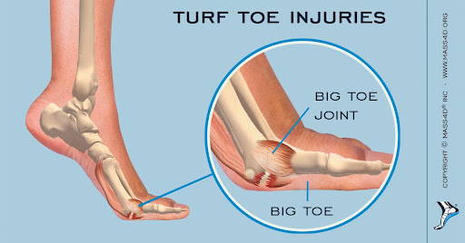 turf toe injury 