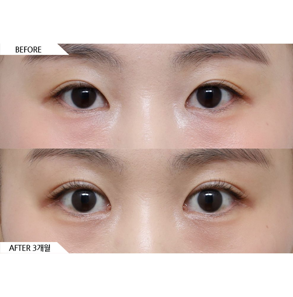 Before and after results of eye revision surgery and canthoplasty showing more defined and natural eye shape in Korea