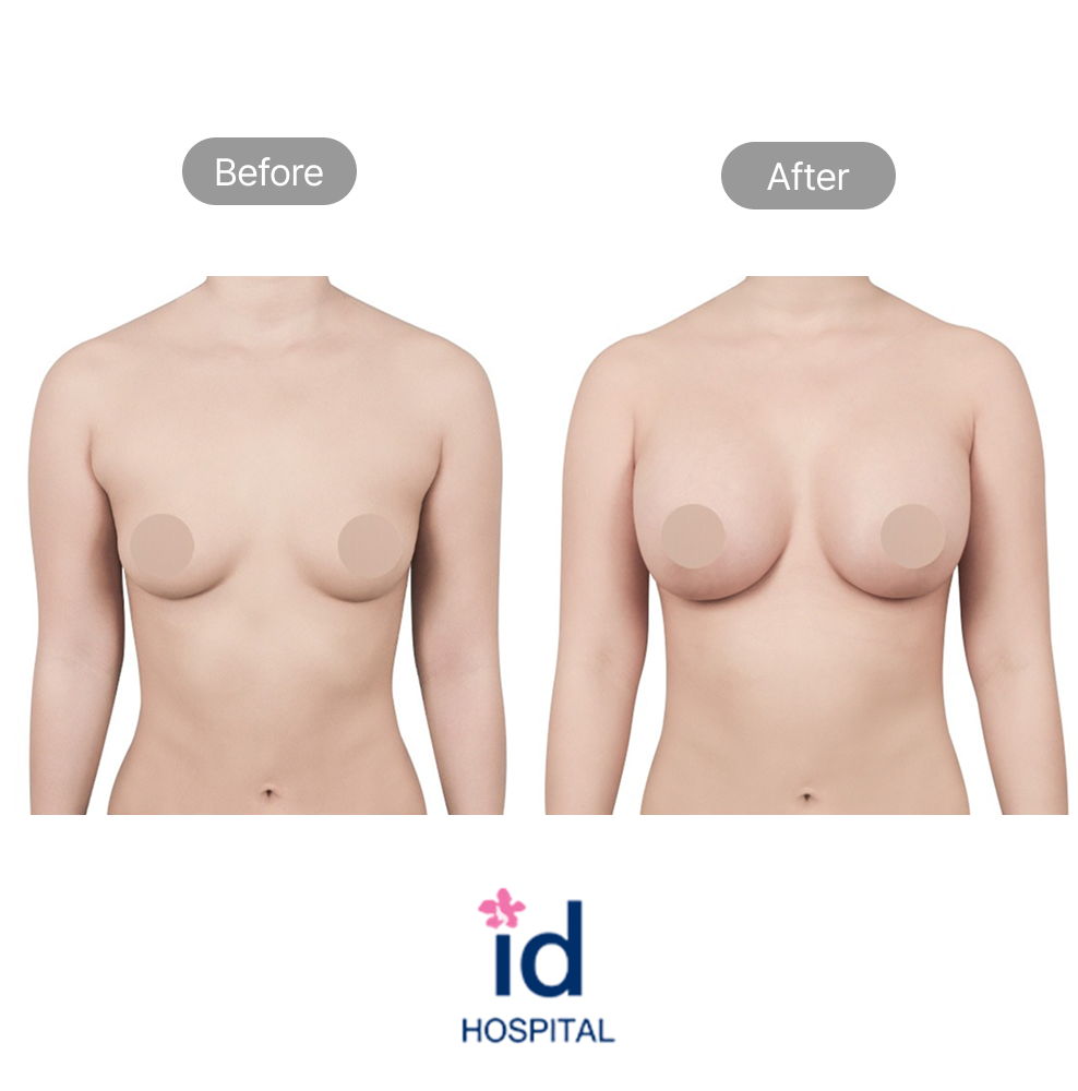 Breast Augmentation Before and After Result at ID Hospital