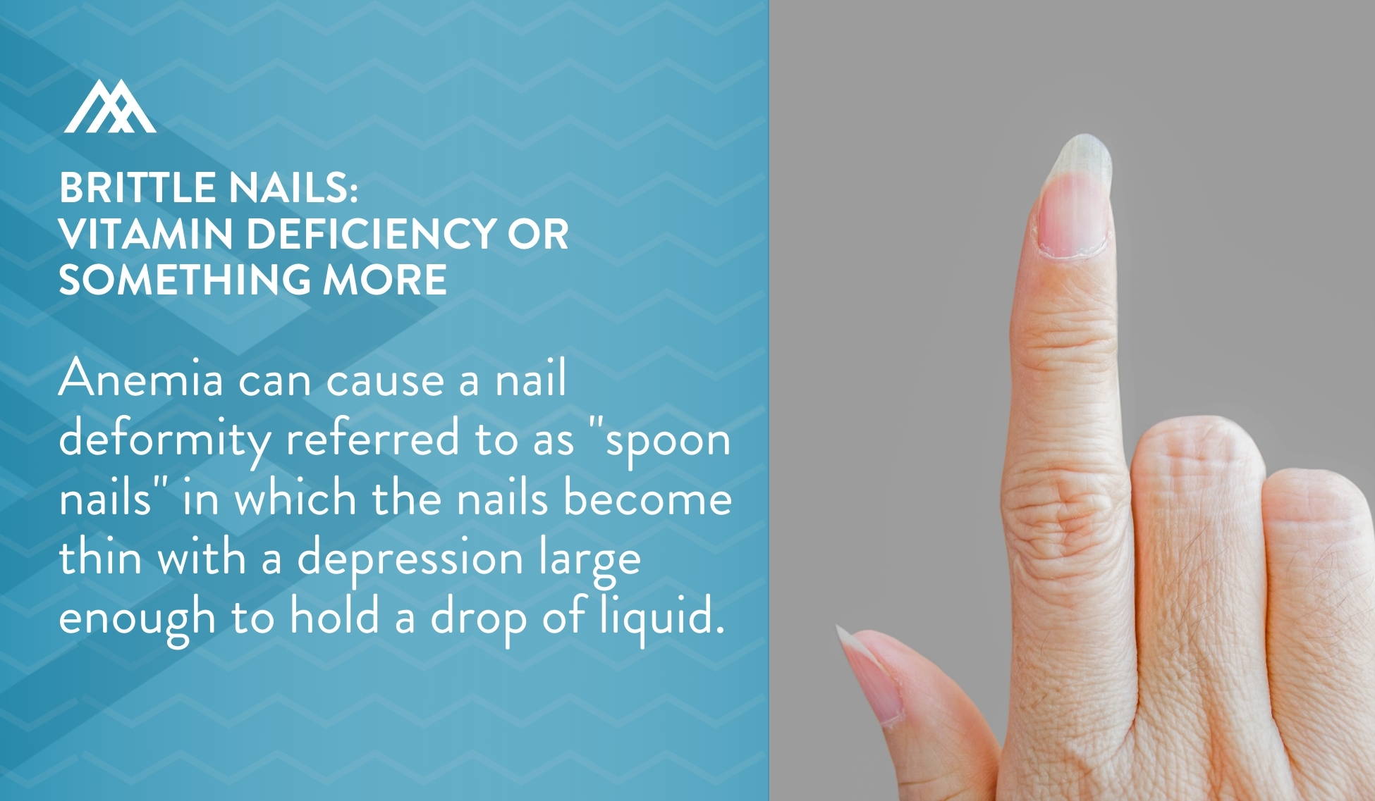 Brittle Nails: Vitamin Deficiency or Something More? - Amandean