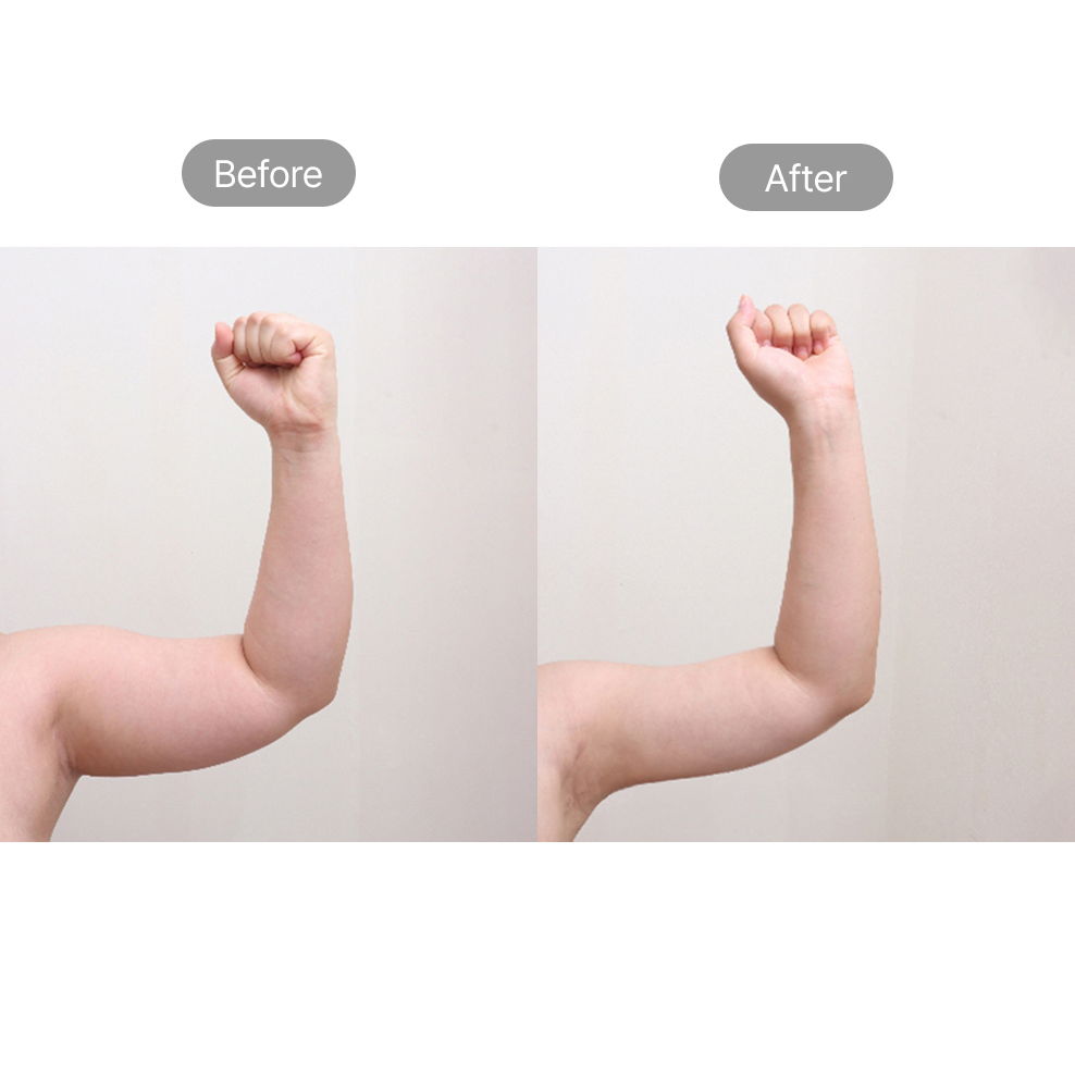 Arm liposuction before and after results for slimmer upper arms at Fresh Dr. Hong in Korea