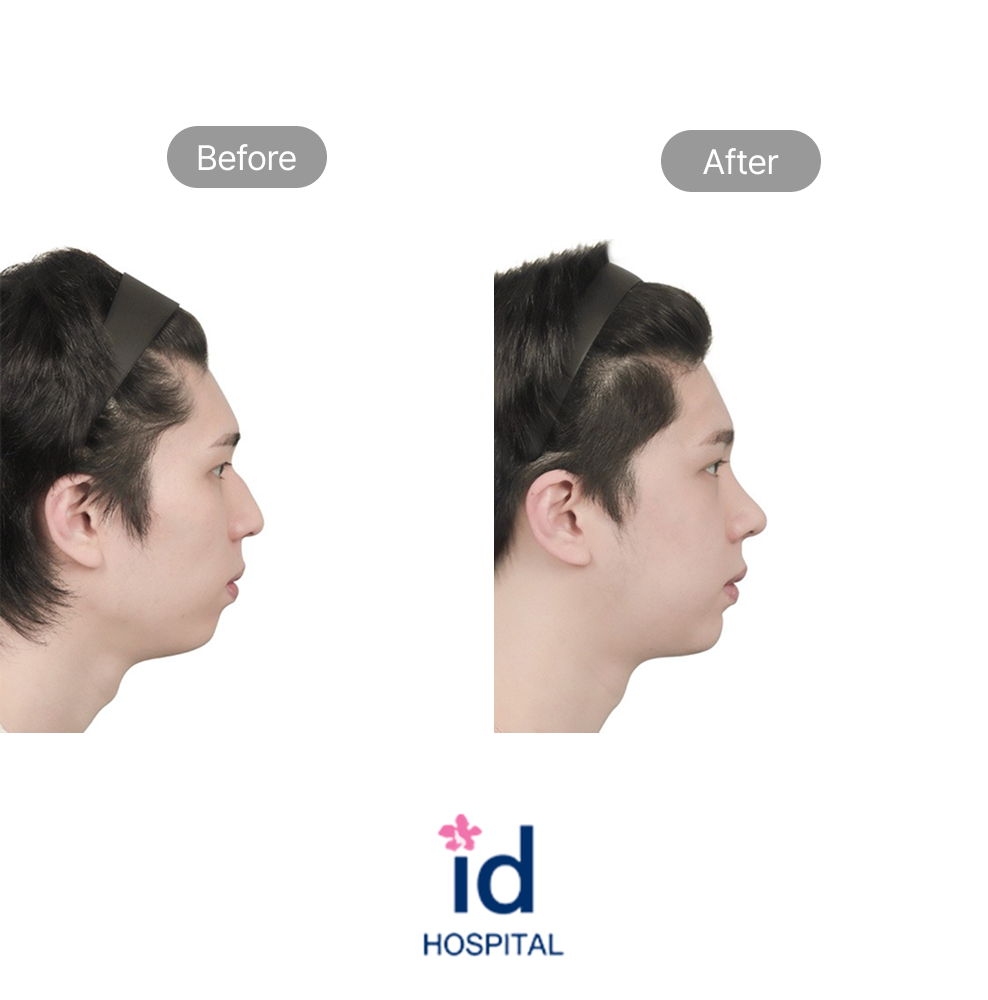 Direct Line Rhinoplasty Side View Before and After Result at ID Hospital