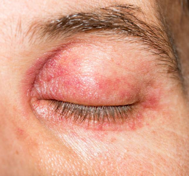 Ein geschlossenes Auge mit angeschwollenem, gerötetem Augenlid. Die Symptome einer Allergie können auch die Lidhaut und die Augenoberfläche betreffen