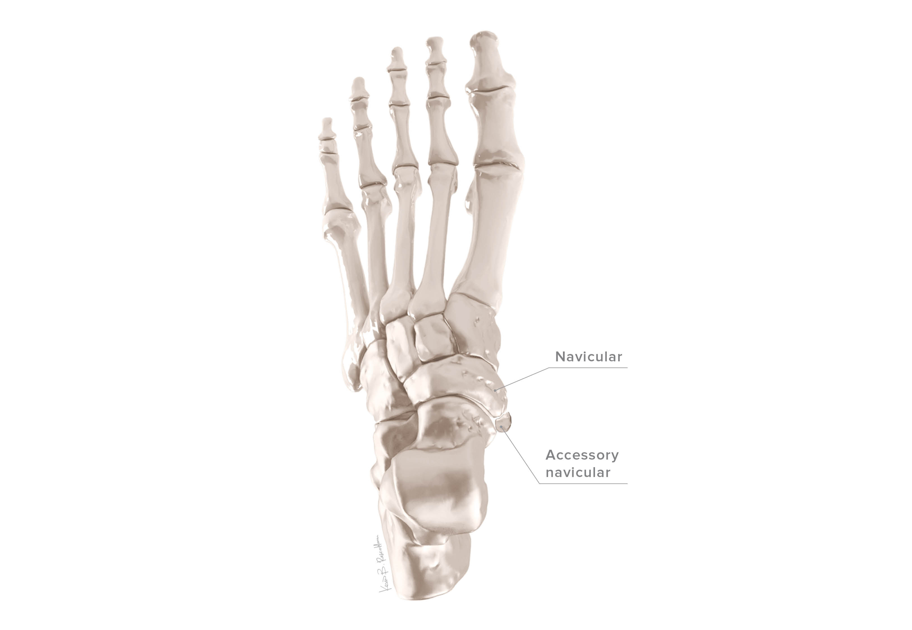 Accessory Navicular Syndrome