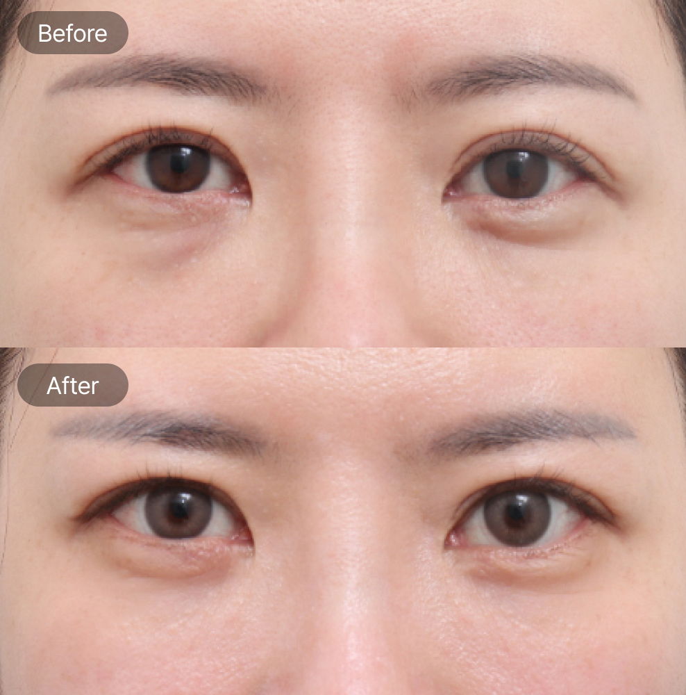 Under eye fat repositioning before and after results at Fresh Dr. Hong Plastic Surgery in Korea