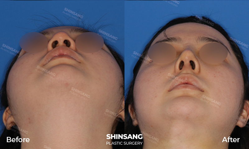 Alar Reduction And Tip Plasty Result At Sinsang Plastic Surgery In Korea