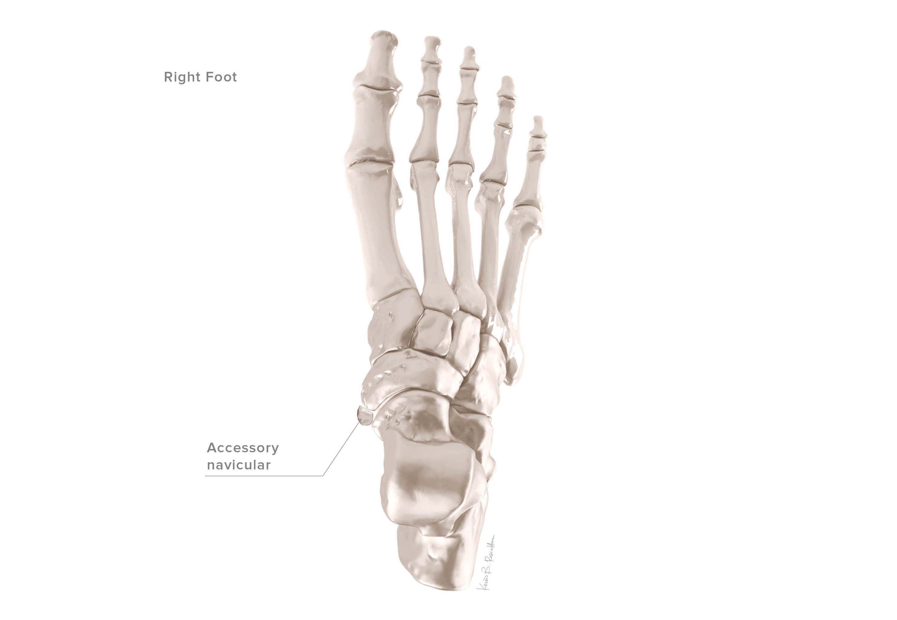 Accessory Navicular Syndrome