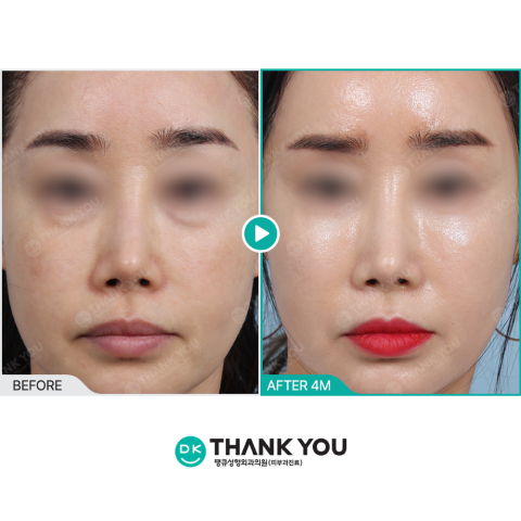 Advanced Korean beauty treatments including skin botox and facial contouring results following personalized Korean skincare and clinical consultation