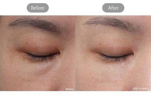 Before And After Review Image Of Under-Eye Injection Treatment At Jfeel Clinic