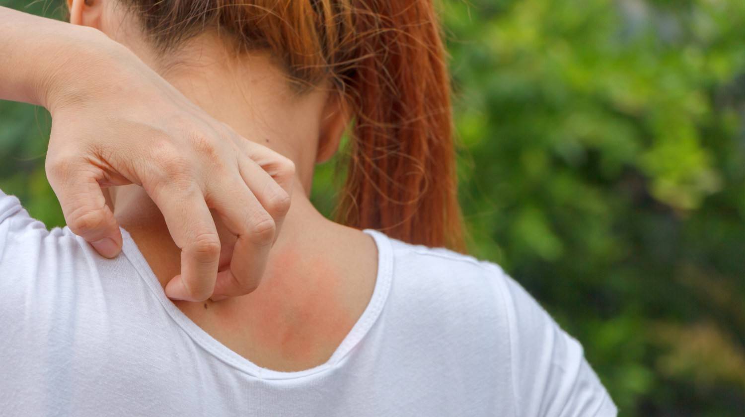 Featured | Women scratch the itch with hand | Home Remedies For Bug Bites | Naturally Treat Bug Bites, Insect Stings, and Their Annoying Itches