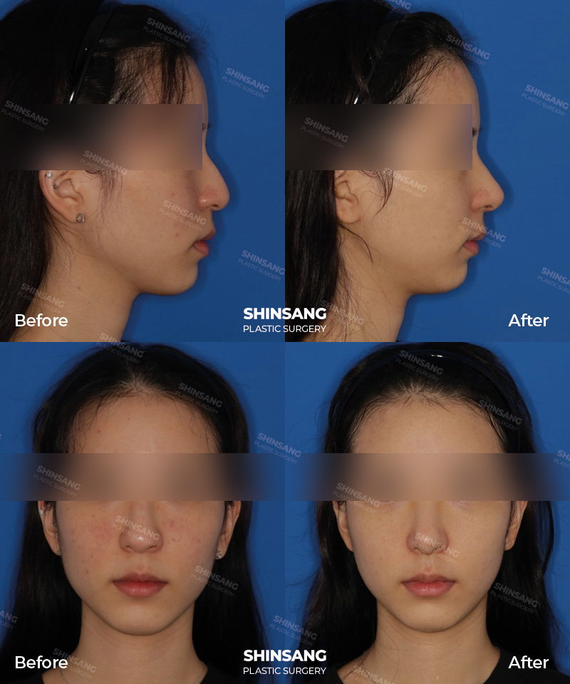 Nasal Bridge Augmentation Hump Reduction And Tip Plasty Result At Sinsang Plastic Surgery In Korea